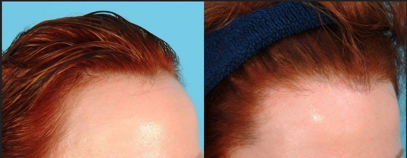 تكلفة زراعة الشعر للنساء - اسعار زراعة الشعر 1128 3