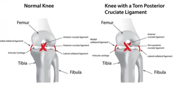 اعراض الرباط الصليبي - علامات واعراض الرباط الصليبي 623 3