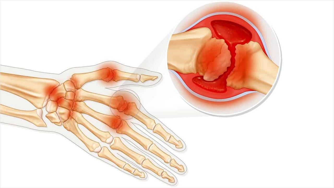 الفرق بين الروماتيزم والروماتويد - امراض العصر الخطيرة 5465 2