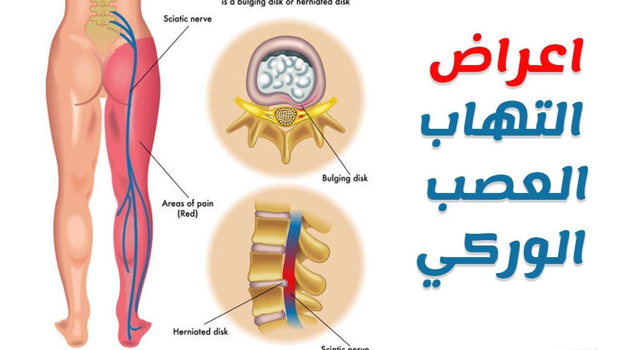 الم العصب الوركي - الام العصب الوركى المزعج وعلاجه