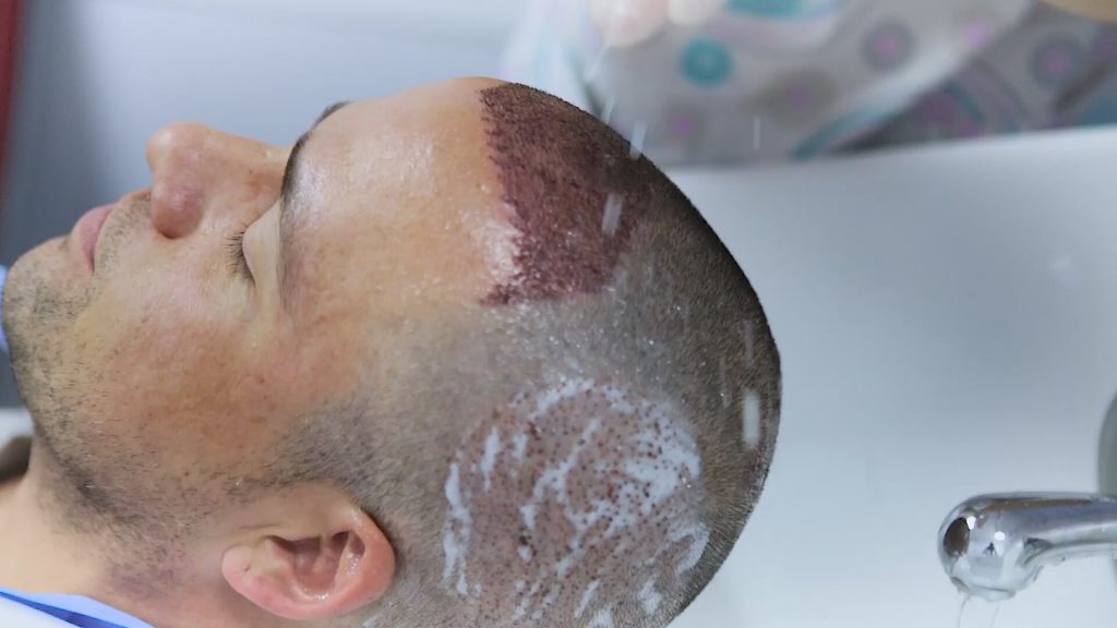 علاج الحكه بعد زراعة الشعر - العنايه الخاصة لعلاج الحكة ما بعد عمليه زراعه الشعر 4589 1