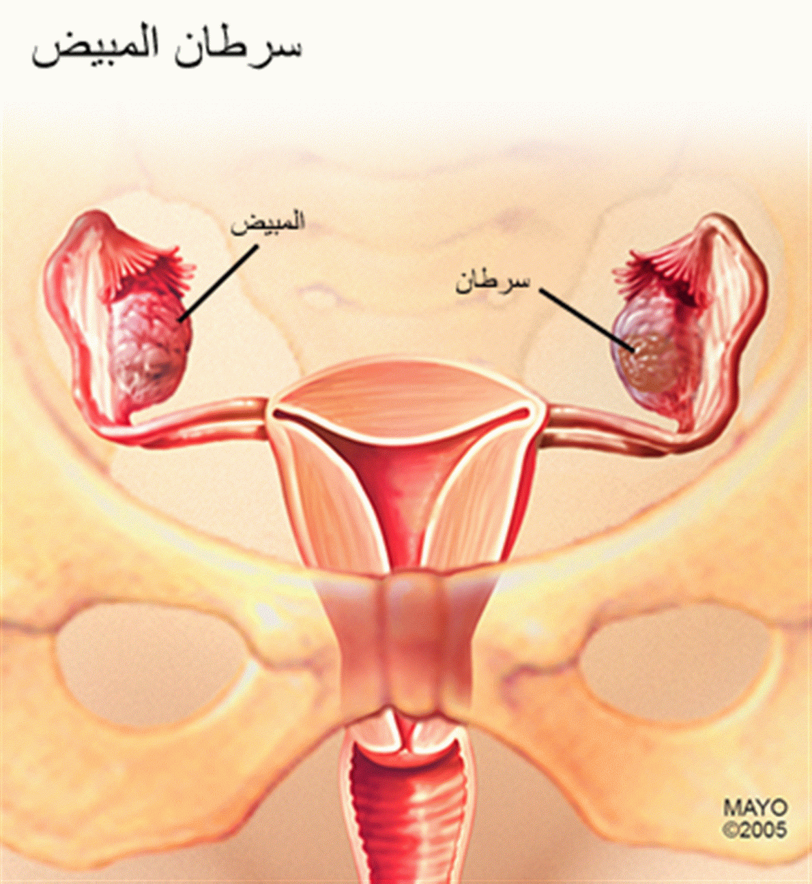 اعراض ورم المبيض