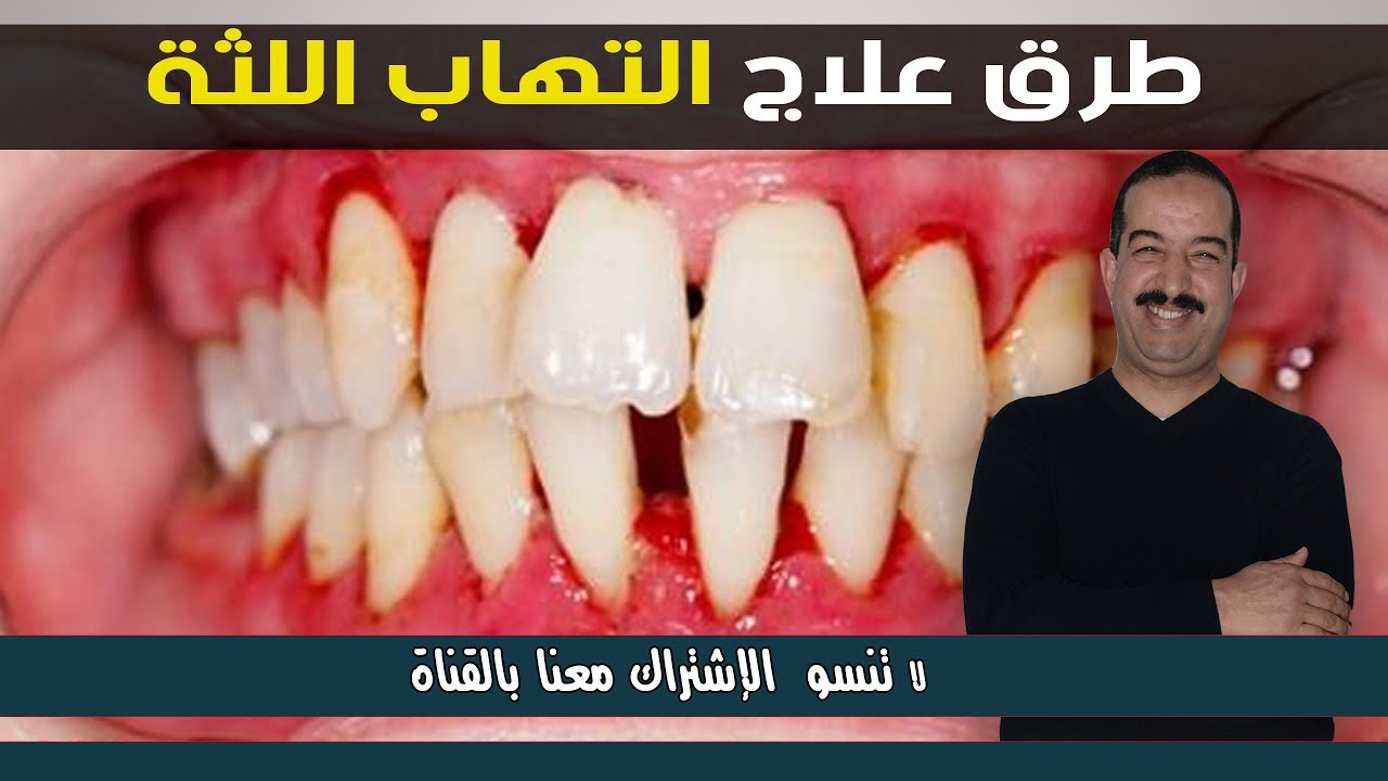 علاج التهاب اللثة , تعرفوا علاج للثه