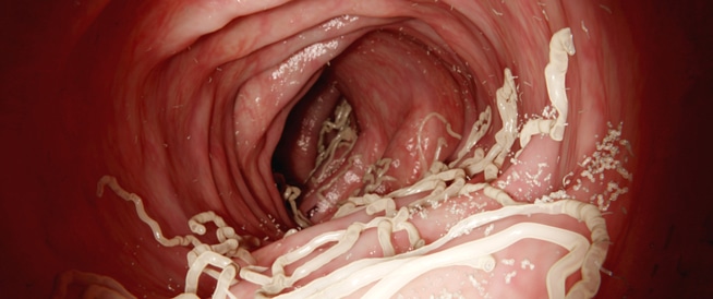 انواع ديدان البطن بالصور , اتعرفي علي انواع الديدان المعده بالصور