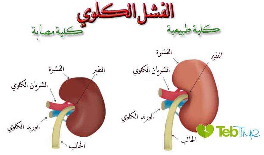 اعراض الفشل الكلوي الحاد - مرض الفشل الكلوى الحاد واعراضه 4687 1