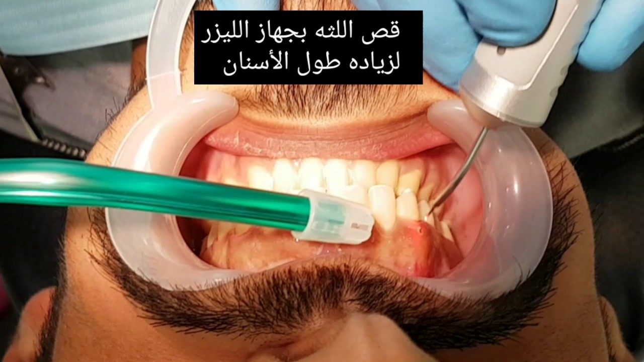 عملية قص اللثة , كيف تتخلص من اللثة