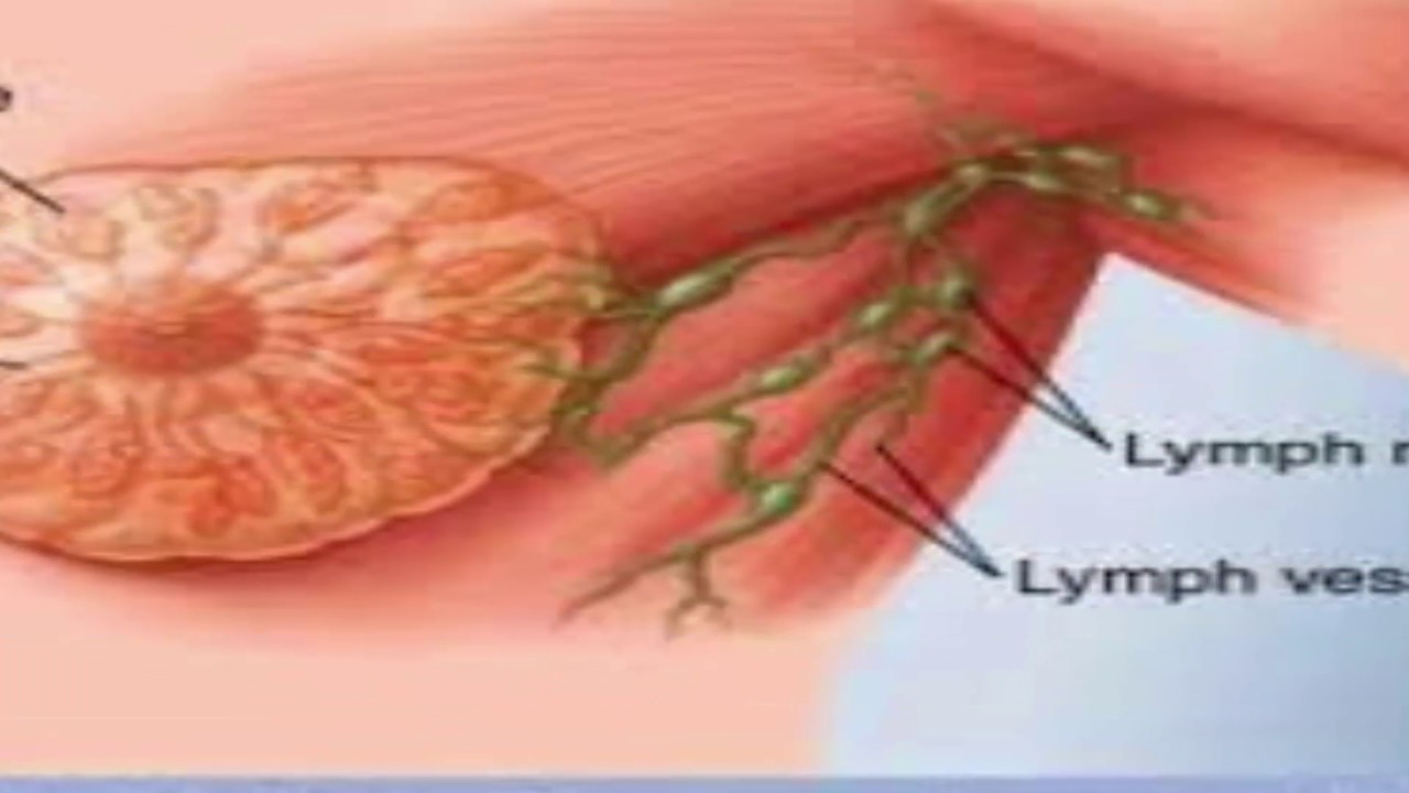 اعراض ورم الثدي , بعض اصناف الطعام تساعدك على عدم الوقوع فى مرض السرطان