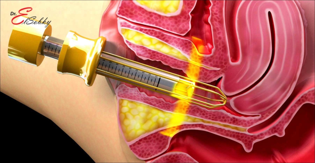 تضييق المهبل بالليزر بالمدينه , احدث عمليات التجميل