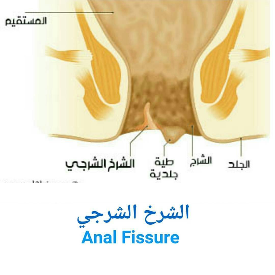 علاج شرخ المستقيم , كن طبيب نفسك وعالج شرخ المستقيم