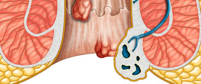 ما هو البواسير - تعرف على البواسير في جسم الانسان 126 2