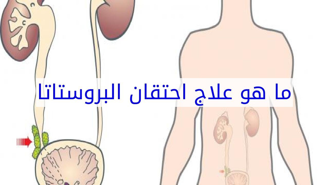 احتقان البروستاتا علاج , تجنب احتقان البروستاتا