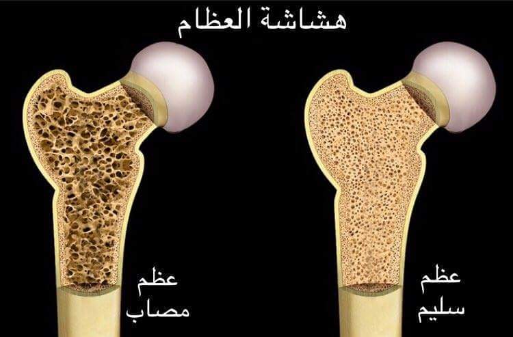 ما هو مرض هشاشة العظام - اسباب هشاشة العظام وطرق علاجه- 1072