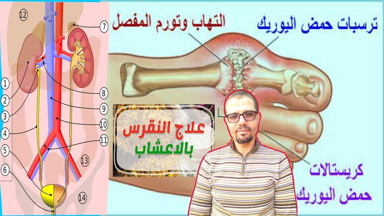 علاج مرض النقرس نهائيا , يلا نشوف علاج النقرس