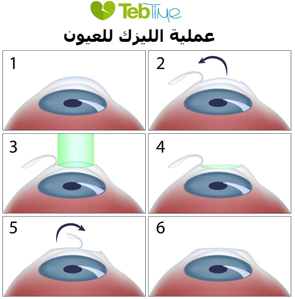 عملية الليزر للعيون , تعرفوا على عملية الليزر