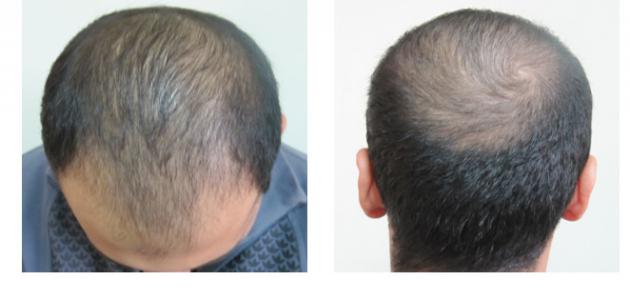 علاج الحكه بعد زراعة الشعر , العنايه الخاصة لعلاج الحكة ما بعد عمليه زراعه الشعر