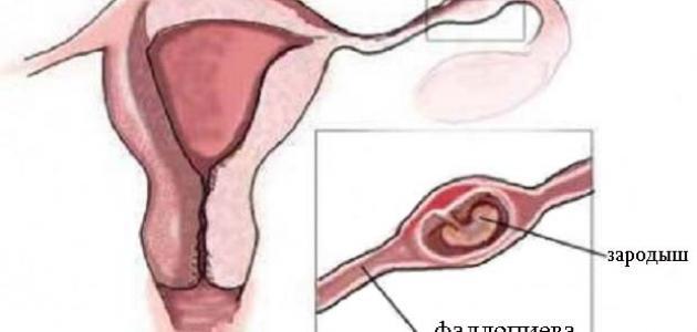 ماهي اسباب نغزات المبيض , اسباب الشعور بنغزات فى المبيض