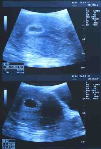 حمل الشهر الاول علامات الحمل في الشهر الاول الحبيب للحبيب