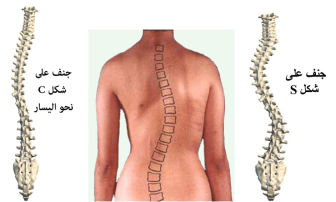 اعراض ميلان العمود الفقري ازاي تعرف ان عندك تقوس في العمود الفقري الحبيب للحبيب